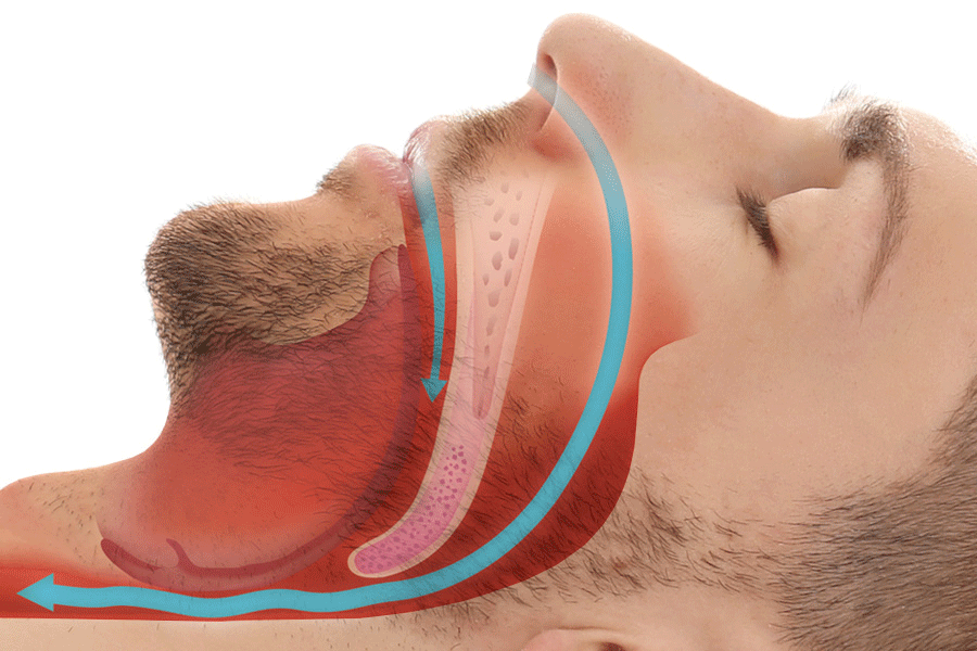 How It Works – SnoreMeds Stop Snoring Solutions