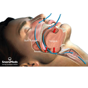 SnoreMeds Value Pack - Stop Snoring & Sleep Peacefully (Dentist Recommended)